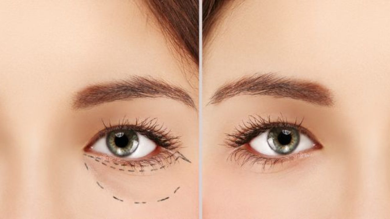 eyelid lifting